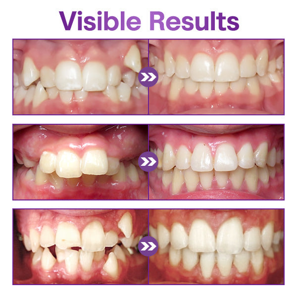 ToothClear Invisible Braces Set